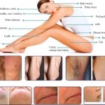 IQPRO Nemesis Diode Laser Hair Removal